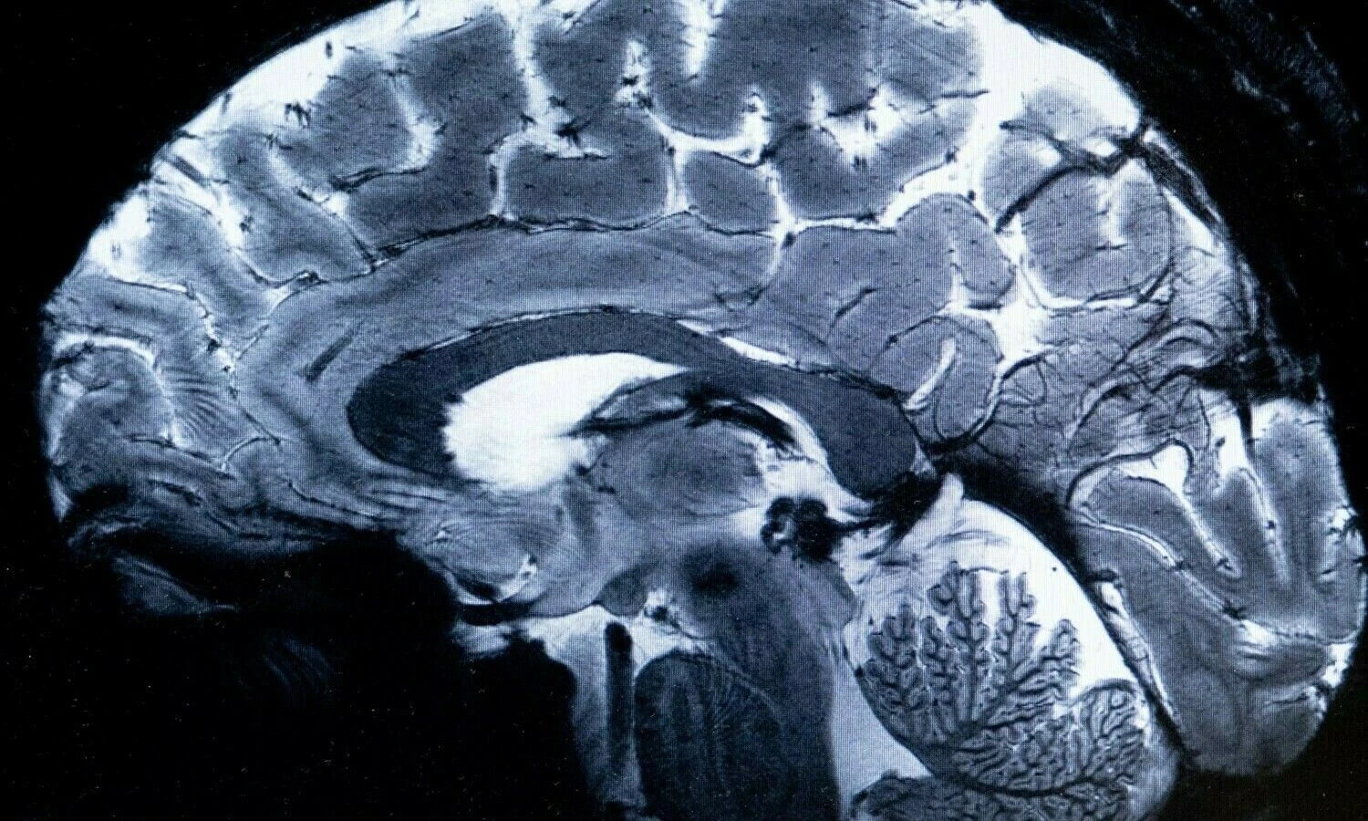 Magnetinio rezonanso tomografu padaryta smegenų nuotrauką. 2024 m. kovo 22 d. „Scanpix“ nuotr.