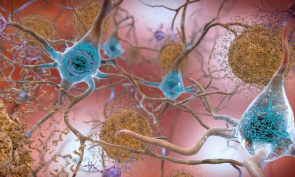 Alzheimerio liga sergančių smegenų ląstelės, kuriose nenormalus beta amiloido baltymo kiekis susikaupia į rudas plokšteles, šios kaupiasi tarp neuronų ir sutrikdo ląstelių funkciją. JAV Nacionalinis senėjimo instituto / AP / „Scanpix“ iliustracija.