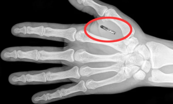 RFID implantavimo procedūra užtrunka daugiausia 10 minučių, o jos kaina svyruoja nuo 80 iki 140 USD. 
„YouTube“ stop kadras.
